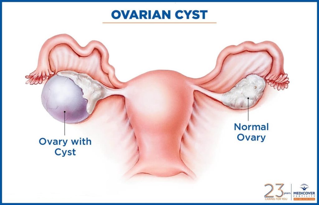 کیست های تخمدان