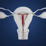 آی یو دی (IUD) چیست؟
