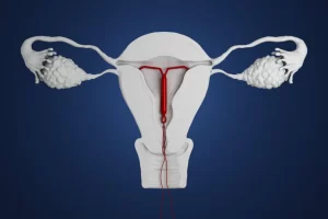 آی یو دی IUD