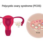 سندرم تخمدان پلی کیستیک (PCOS)