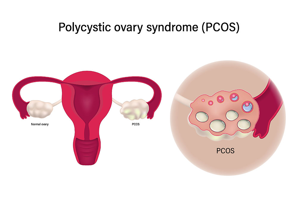 سندرم تخمدان پلی کیستیک (PCOS)