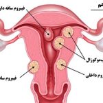 فیبروم رحمی چیست و درمان آن چگونه است؟