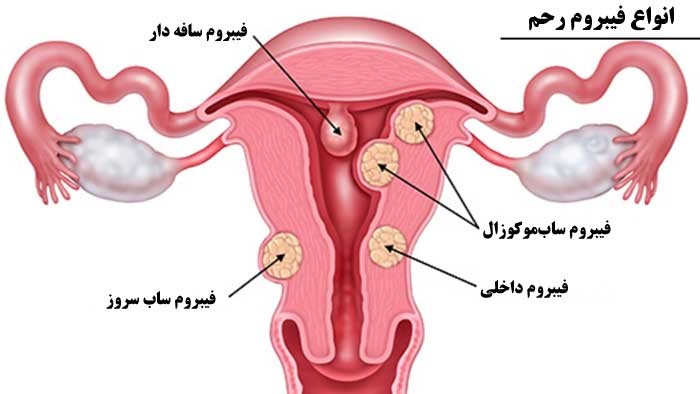 فیبروم رحمی