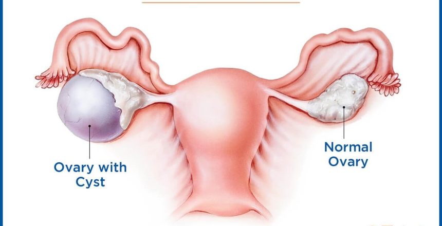 کیست های تخمدان