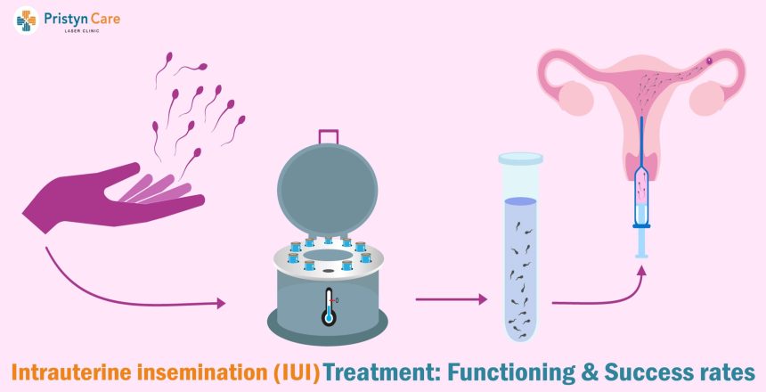 آی یو آی (IUI)