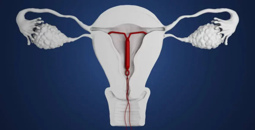 آی یو دی IUD