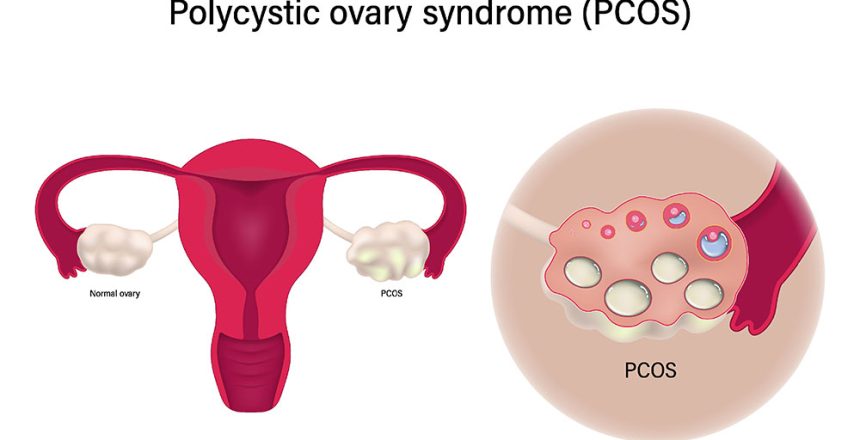 سندرم تخمدان پلی کیستیک (PCOS)