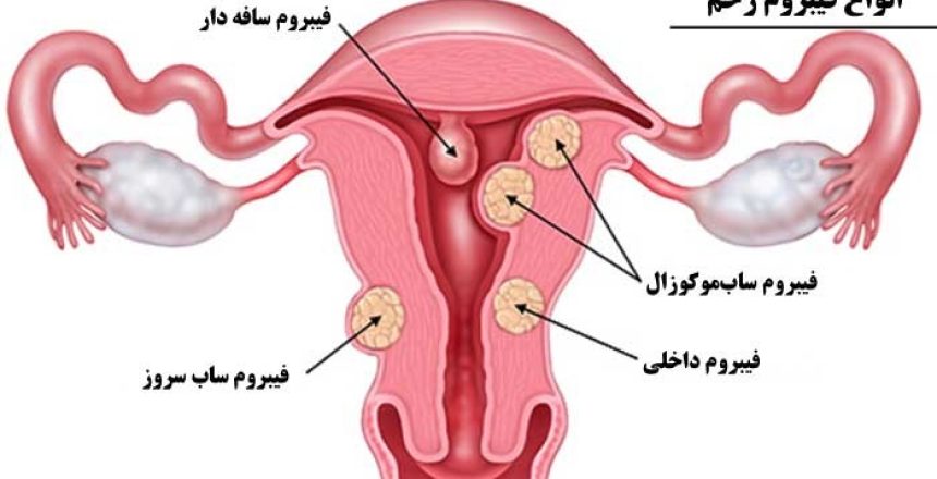 فیبروم رحمی